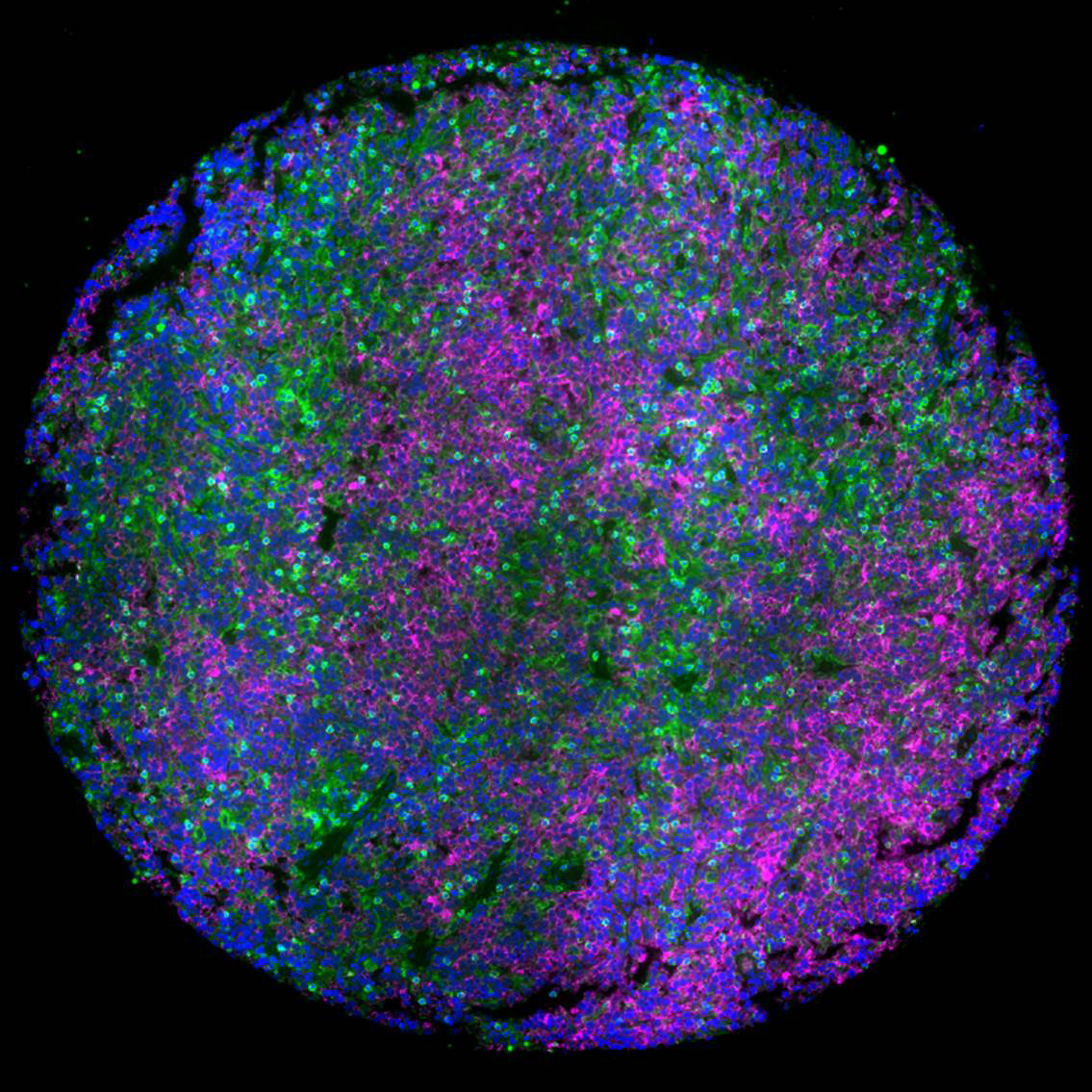 Lymph node tumor microenvironment of lymphomas with malignant B cells (magenta) surrounded by T cells (green)
